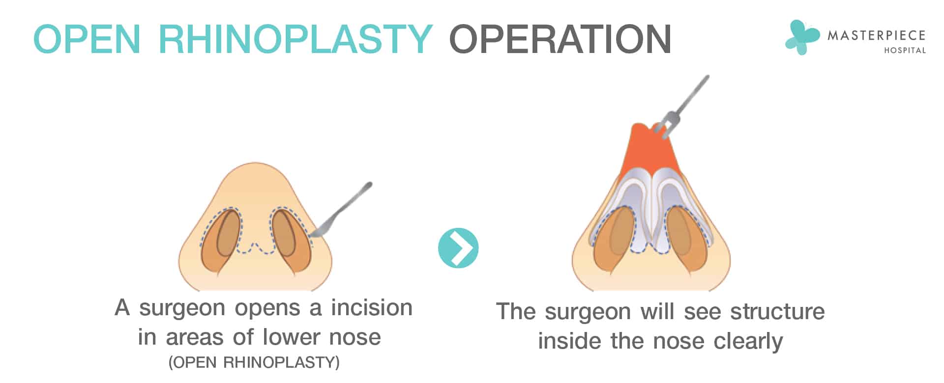 Open Rhinoplasty Operation