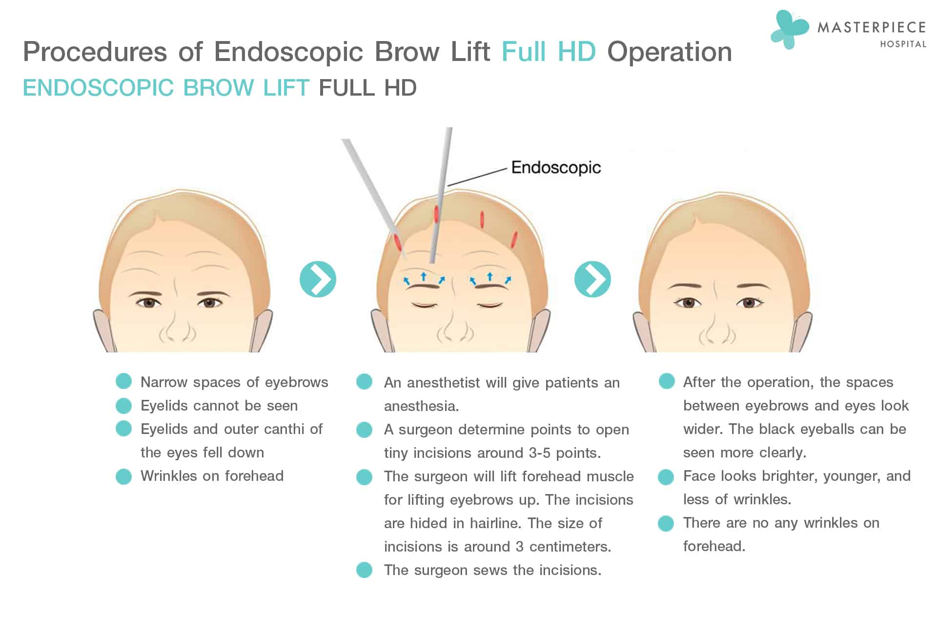 Procedures of Endoscopic Brow Lift Full HD Operation