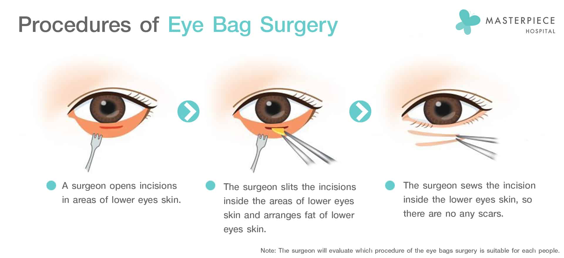 Procedures of Eye Bag Surgery