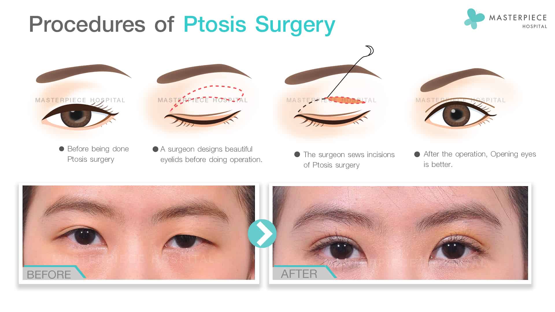 Procedures of Ptosis Surgery
