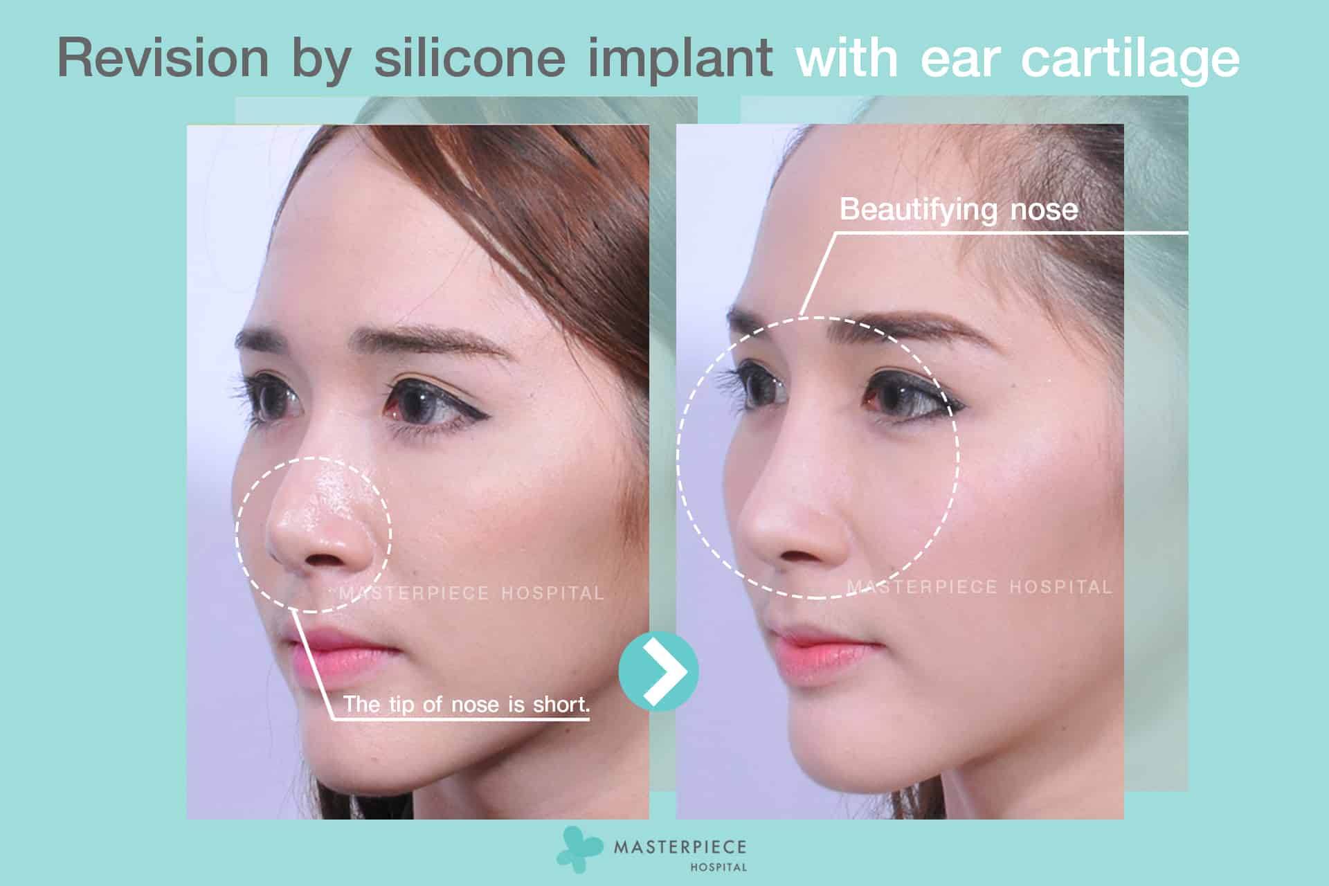 Revision by silicone implant with ear cartilage