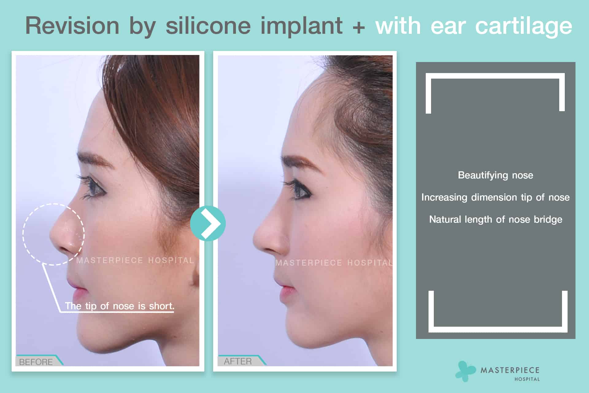 Revision by silicone implant with ear cartilage