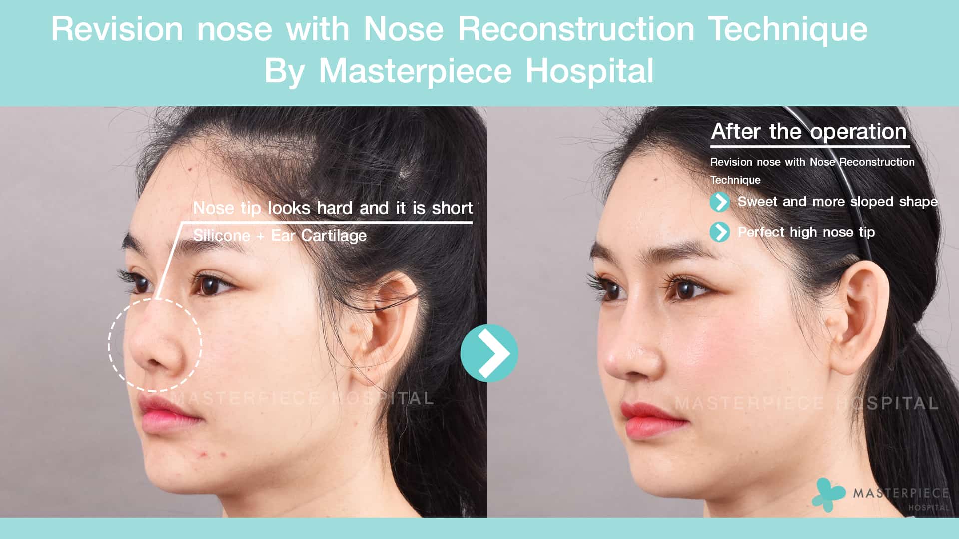 Revision nose with Nose Reconstruction Technique