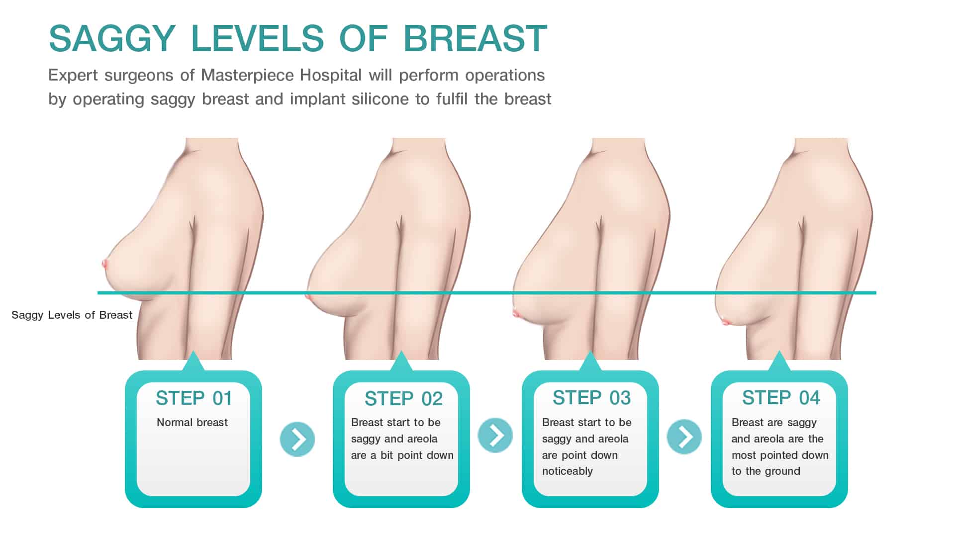 Saggy Levels of Breast