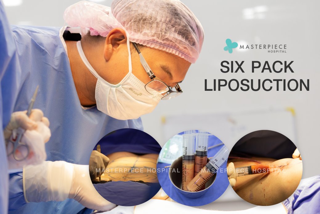 Six Pack Abs Vaser Liposuction Masterpiece Hospital