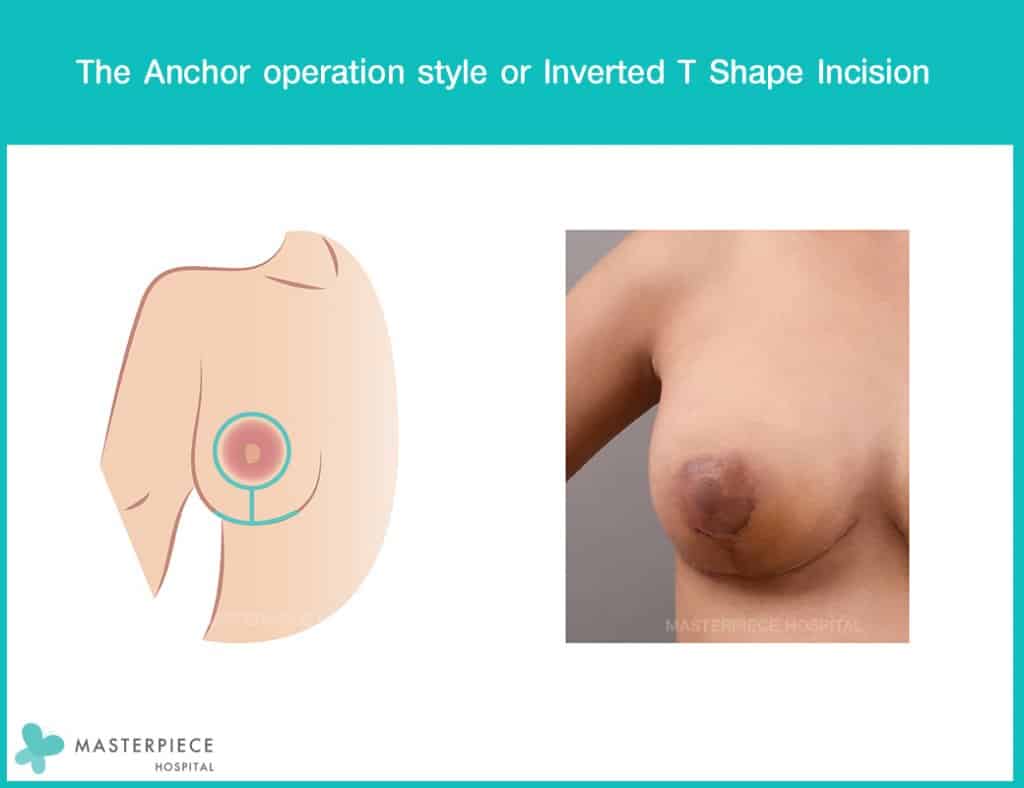 The Anchor operation style or Inverted T Shape Incision