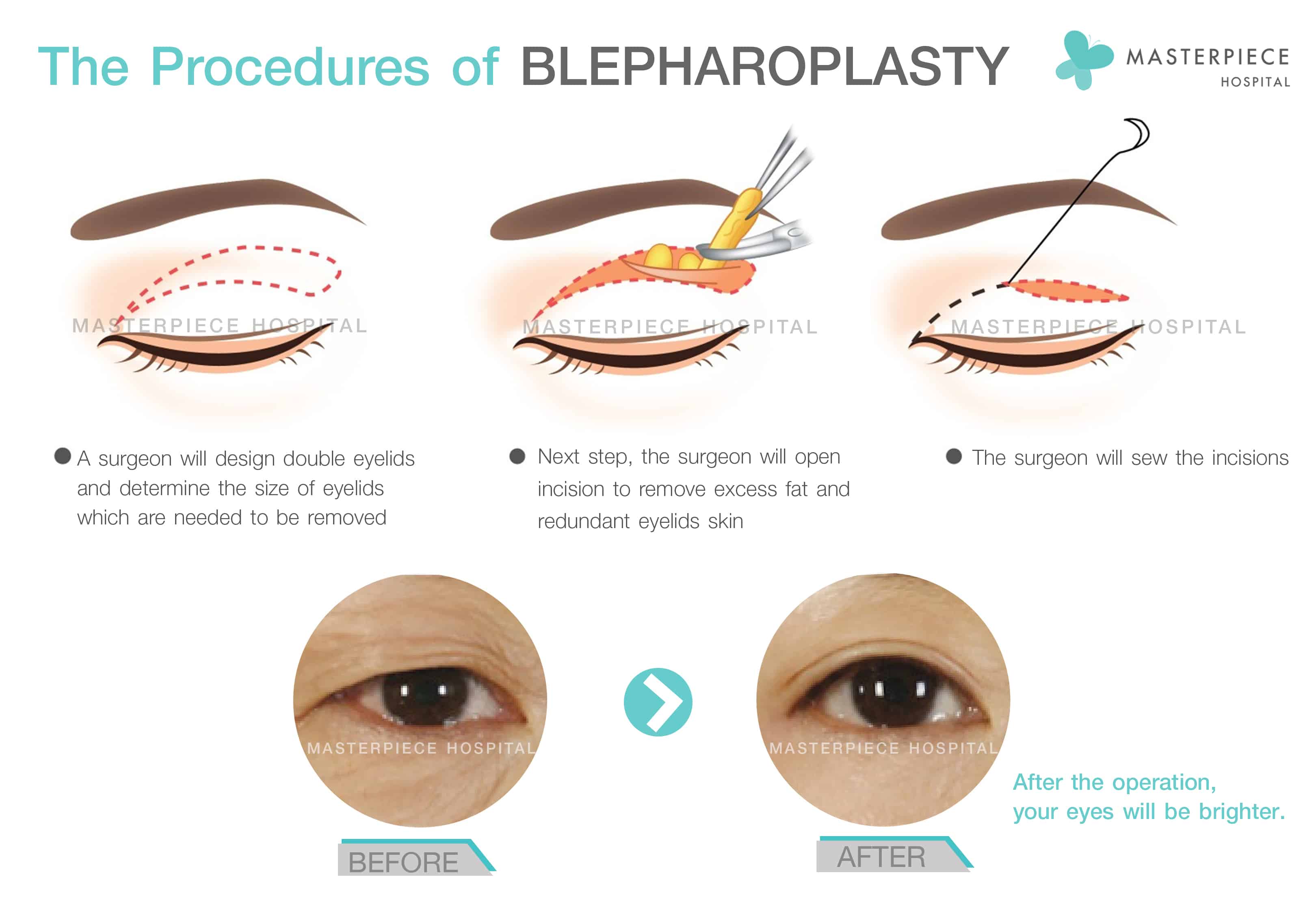 The Procedures of Blepharoplasty at Masterpiece Hospital