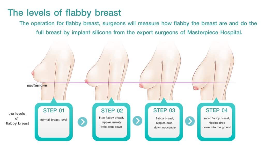 The levels of flabby breast