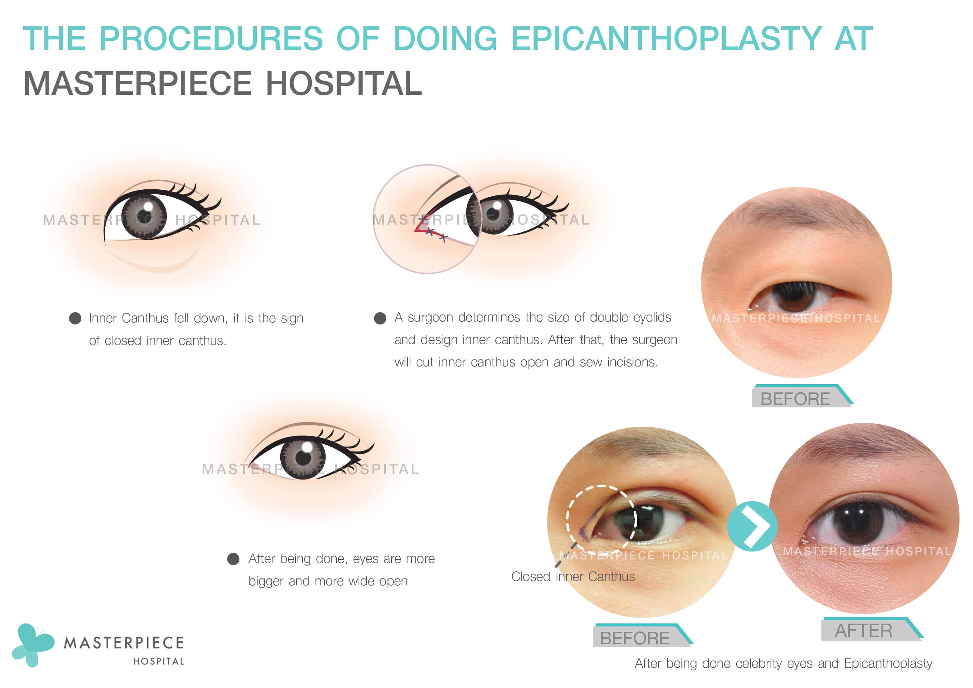 The procedures of doing Epicanthoplasty at Masterpiece Hospital