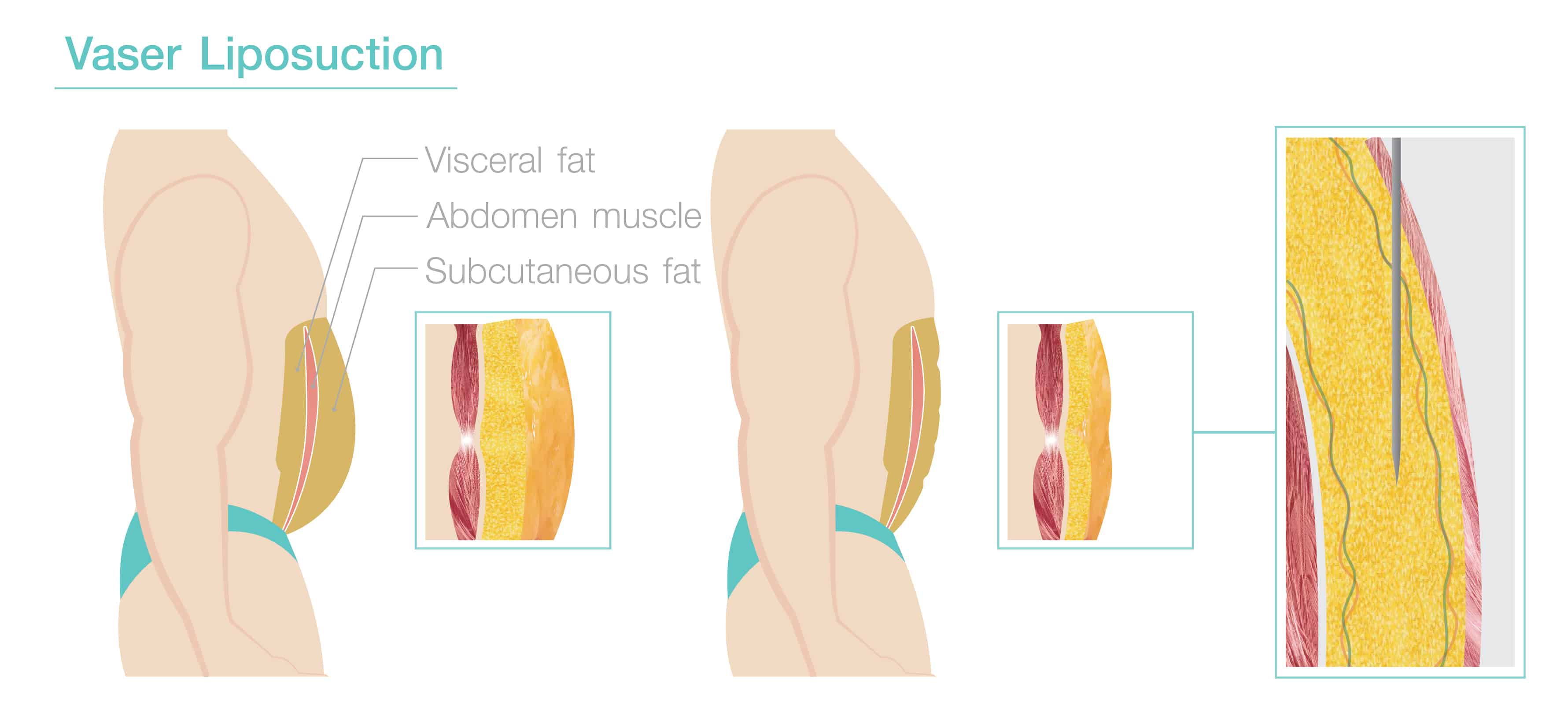 Vaser Liposuction