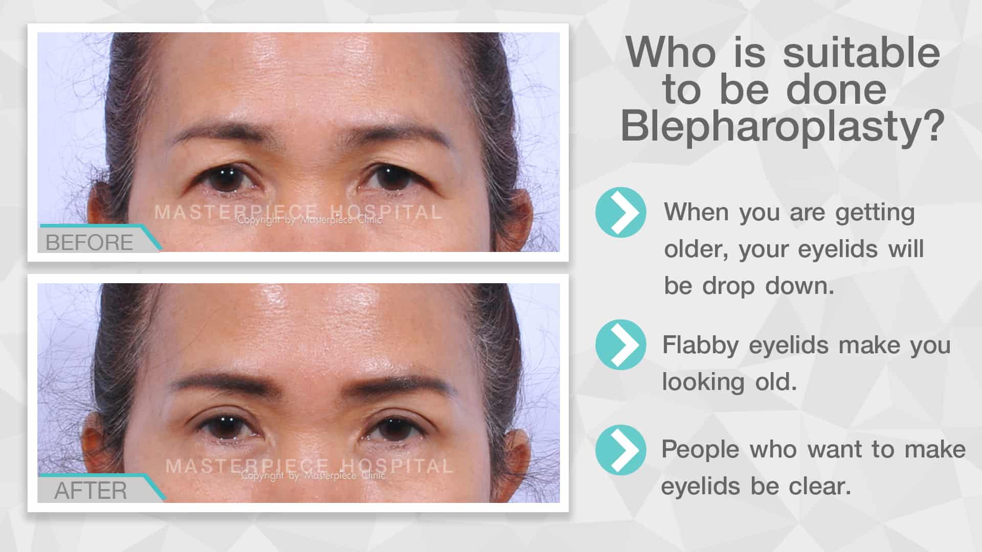 Who is suitable to be done Blepharoplasty?