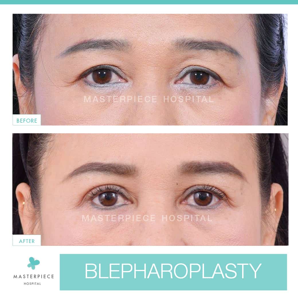 before and after Blepharoplasty