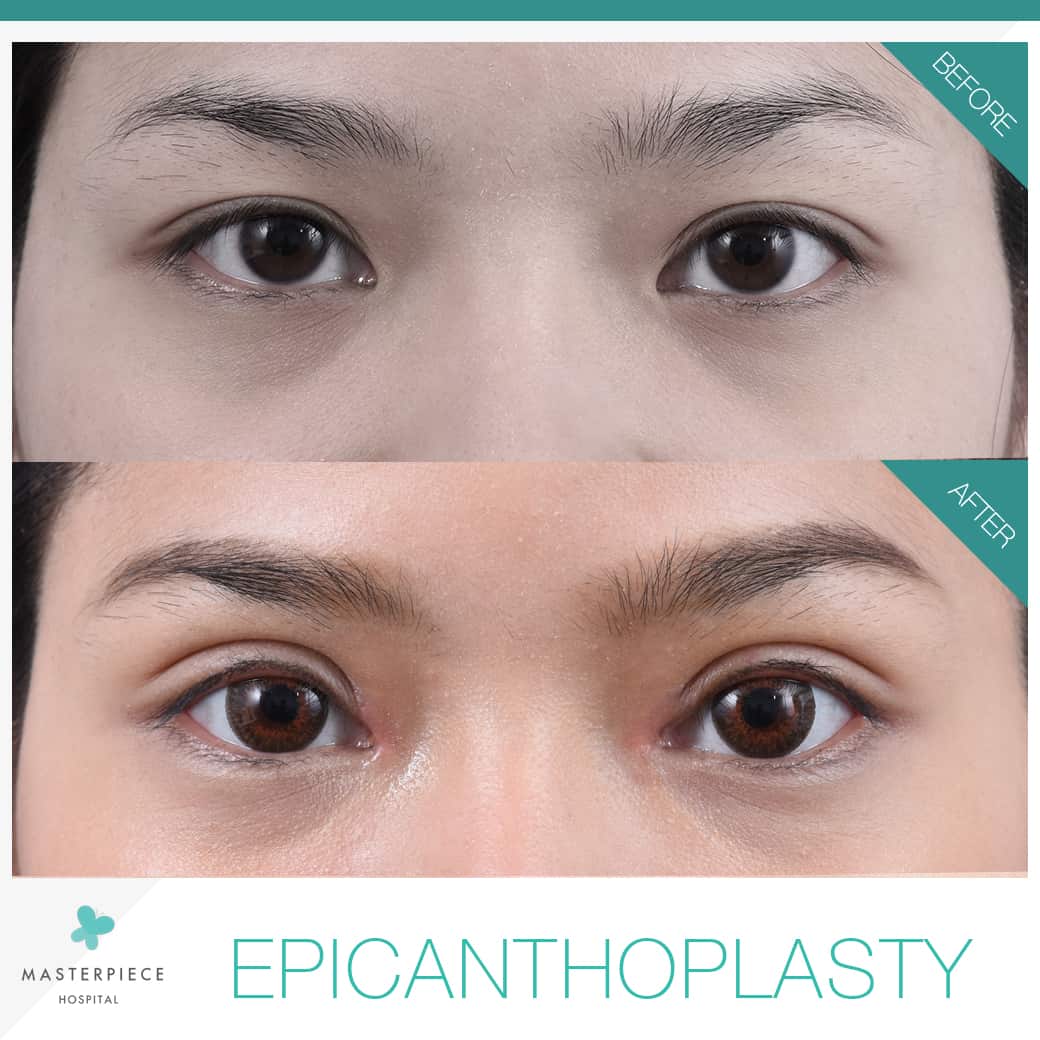 EPICANTHOPLASTY