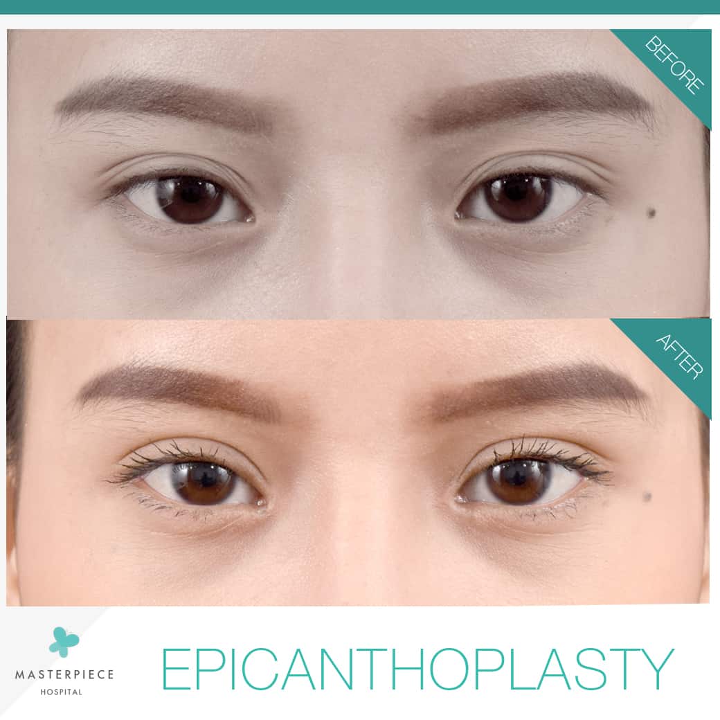 EPICANTHOPLASTY