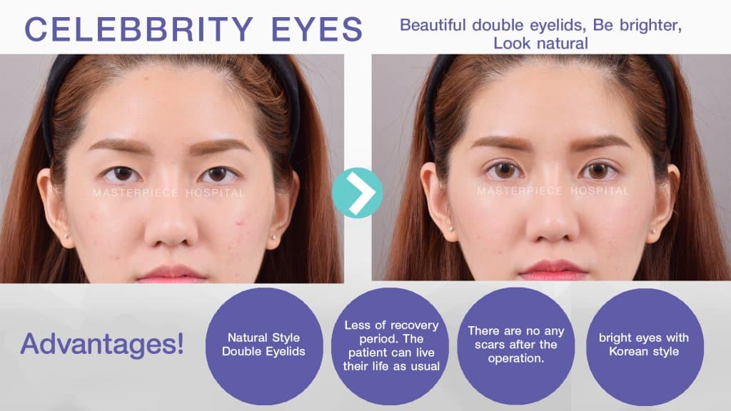 Beautiful double eyelids, Be brighter, Look natural