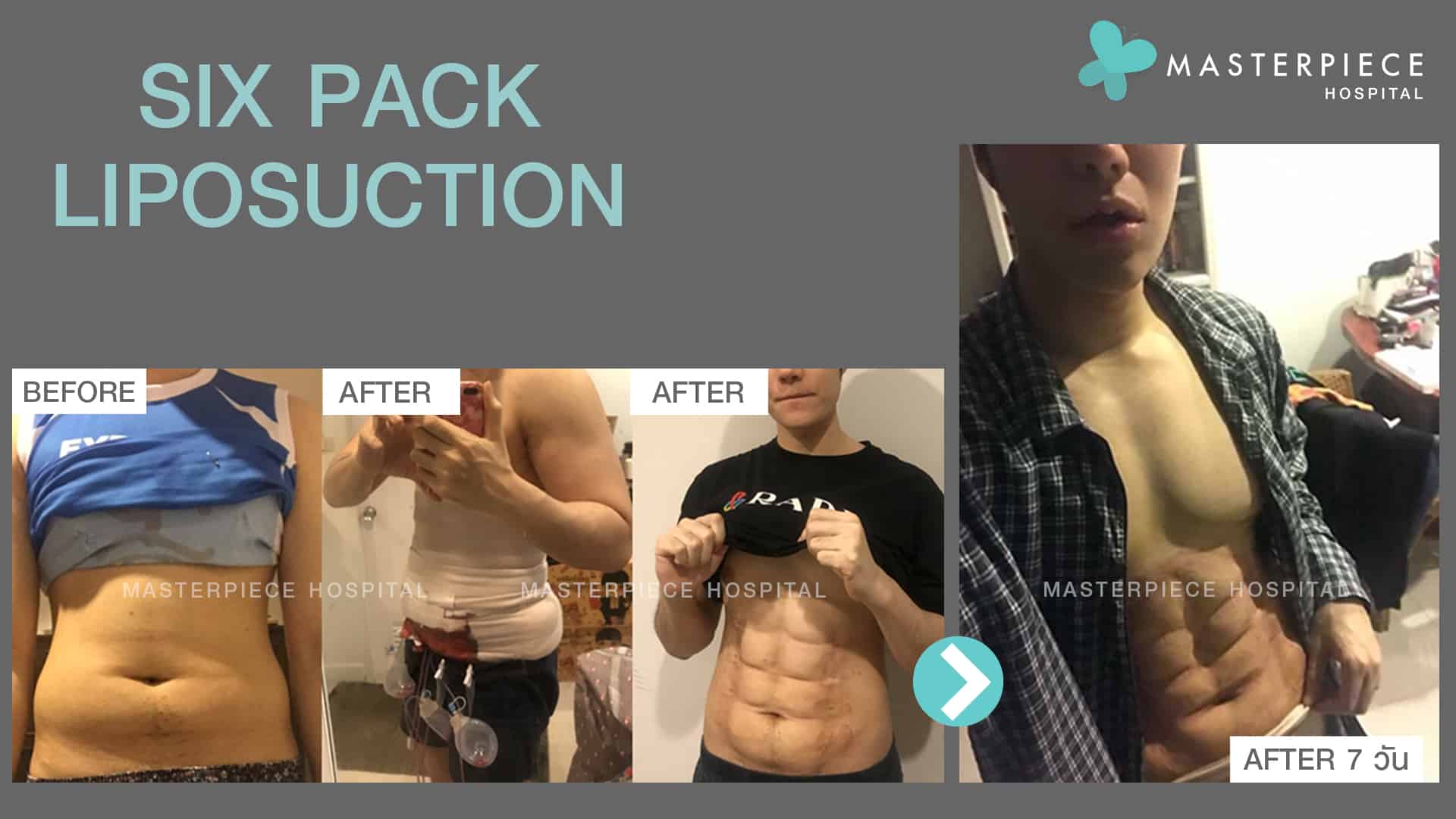Six pack Liposuction review