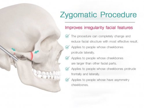 Zygomatic Procedure