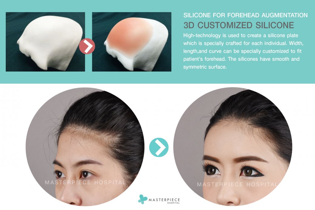 3D Customized Silicone Implant_en