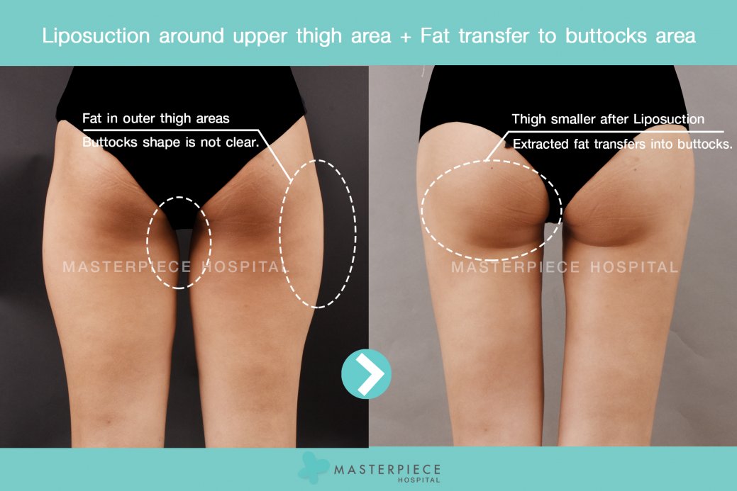 Liposuction around upper thigh area