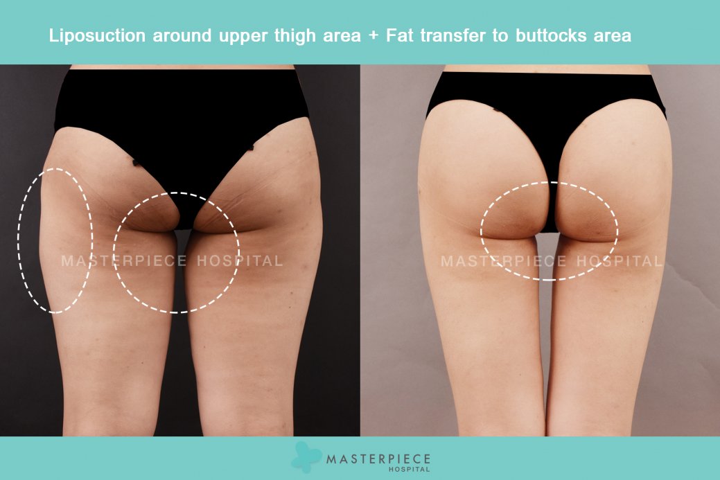 Liposuction around upper thigh area