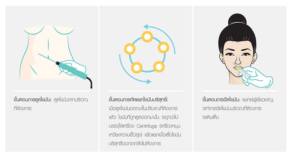 วิธีการฉีดนมด้วยไขมัน Fat Transfer