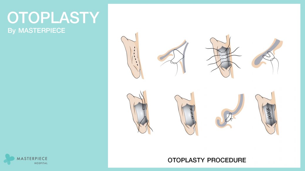 OTOPLASTY