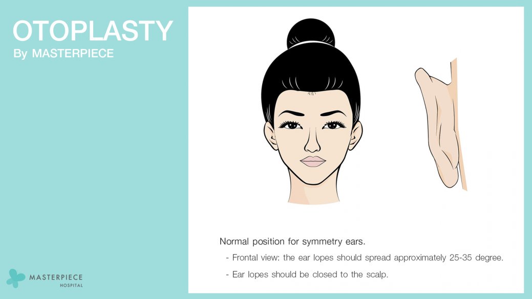 OTOPLASTY