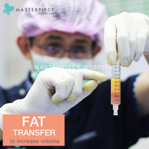 Fat transfer to increase volume