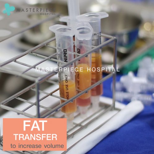 Fat transfer to increase volume
