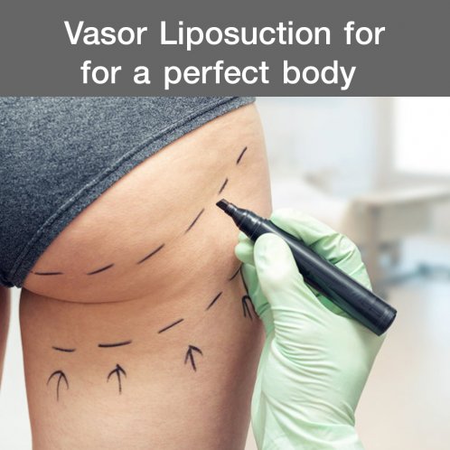 Vasor Liposuction