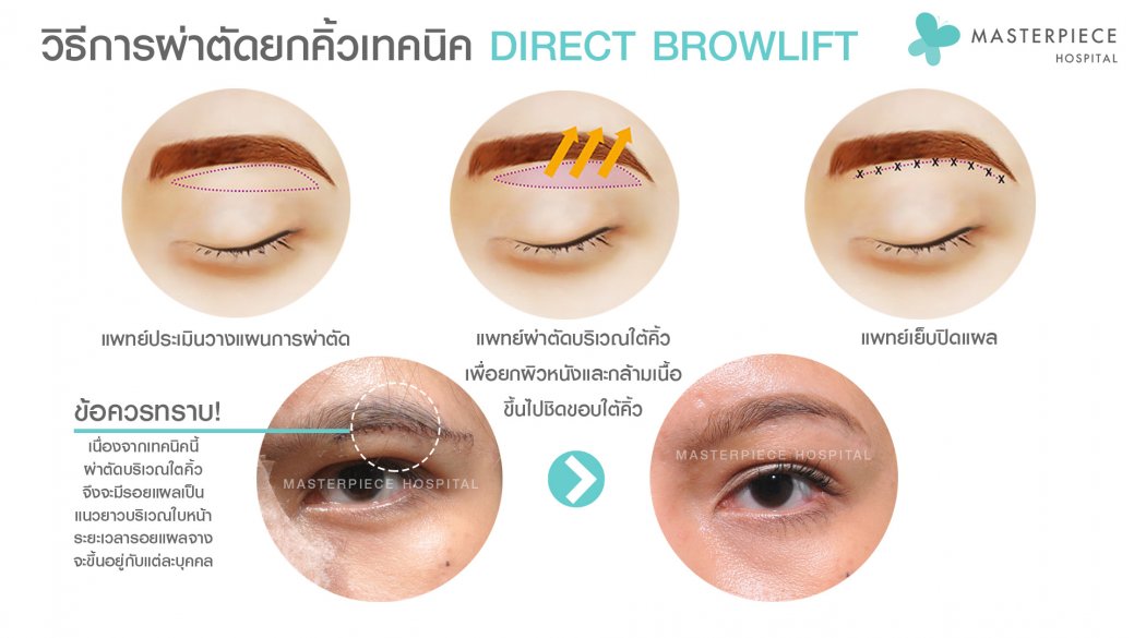 วิธีผ่าตัด-direct วิธีผ่าตัด-direct