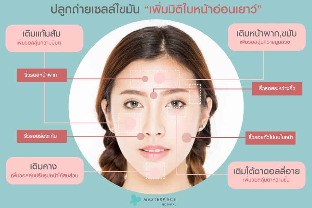 Fat transfer เพิ่มมิติใบหน้าอ่อนเยาว์