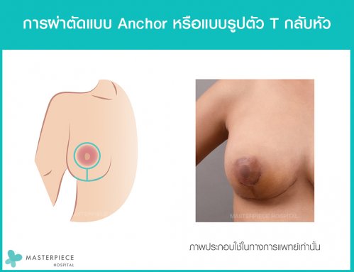 เทคนิคการผ่าตัดแบบ Anchor