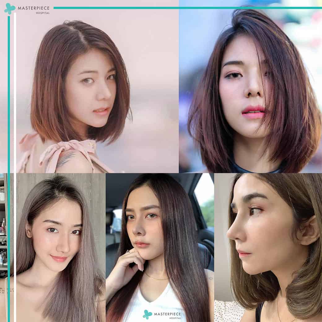 เสริมจมูกที่ รพ. Masterpiece Hospital