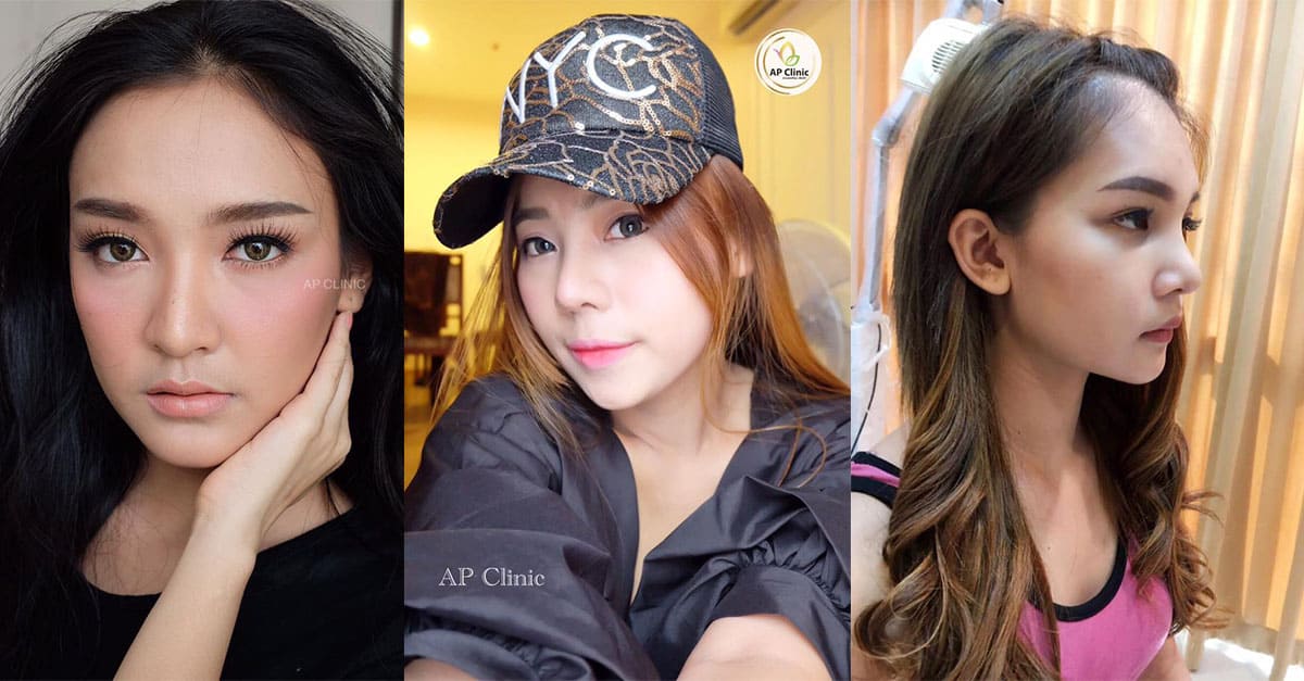 ปักหมุด !! 5 Location “เสริมจมูก” ปี 2019 ฝีมือหมอขั้นเทพ !