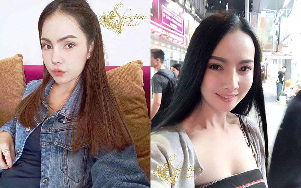 ปักหมุด !! 5 Location “เสริมจมูก” ปี 2019 ฝีมือหมอขั้นเทพ !