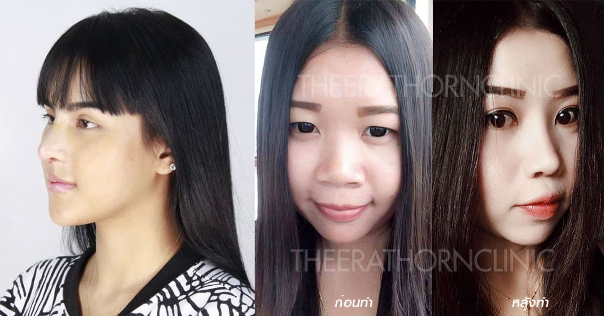 ปักหมุด !! 5 Location “เสริมจมูก” ปี 2019 ฝีมือหมอขั้นเทพ !