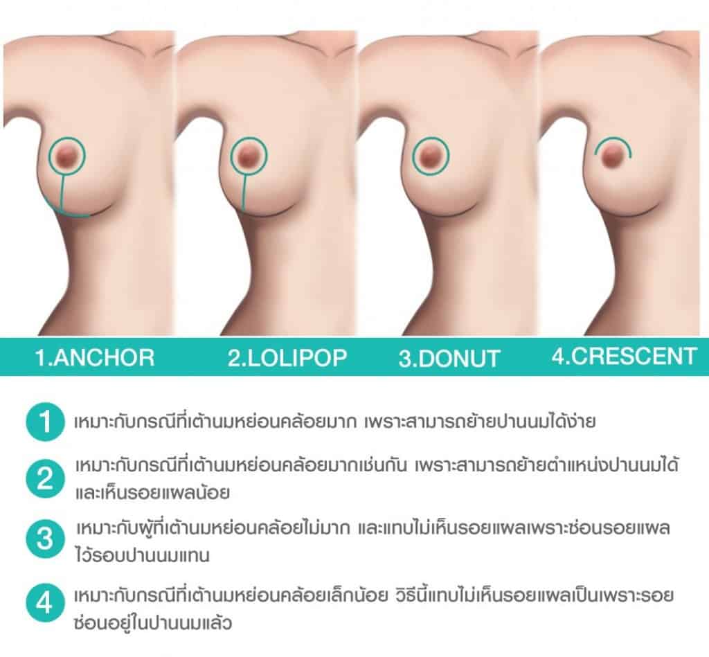 เทคนิคการผ่าตัด