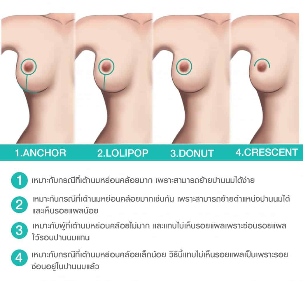เทคนิคการผ่าตัด ยกกระชับทรวงอก หลังคลอดบุตร