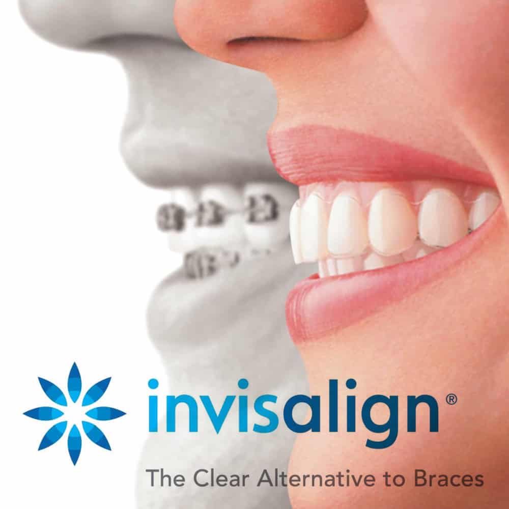 การจัดฟันแบบใสถอดได้ Invisalign