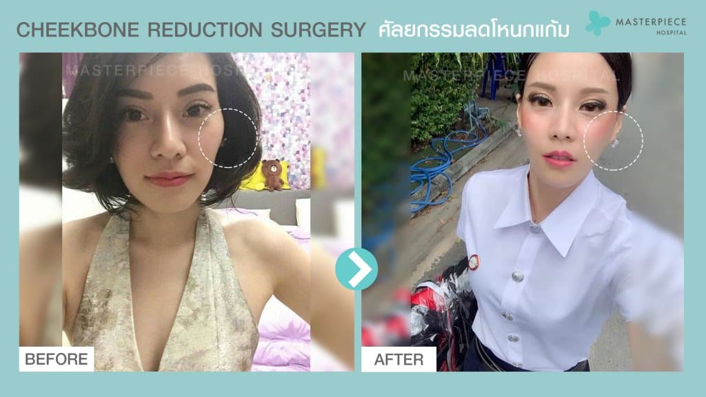 B&A ก่อนหลังศัลยกรรมลดโหนกแก้มลดโหนกแก้ม