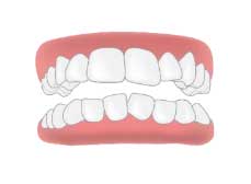การจัดฟันแบบใสถอดได้ Invisalign