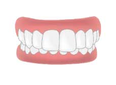 การจัดฟันแบบใสถอดได้ Invisalign