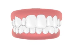 การจัดฟันแบบใสถอดได้ Invisalign