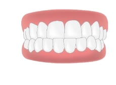 การจัดฟันแบบใสถอดได้ Invisalign