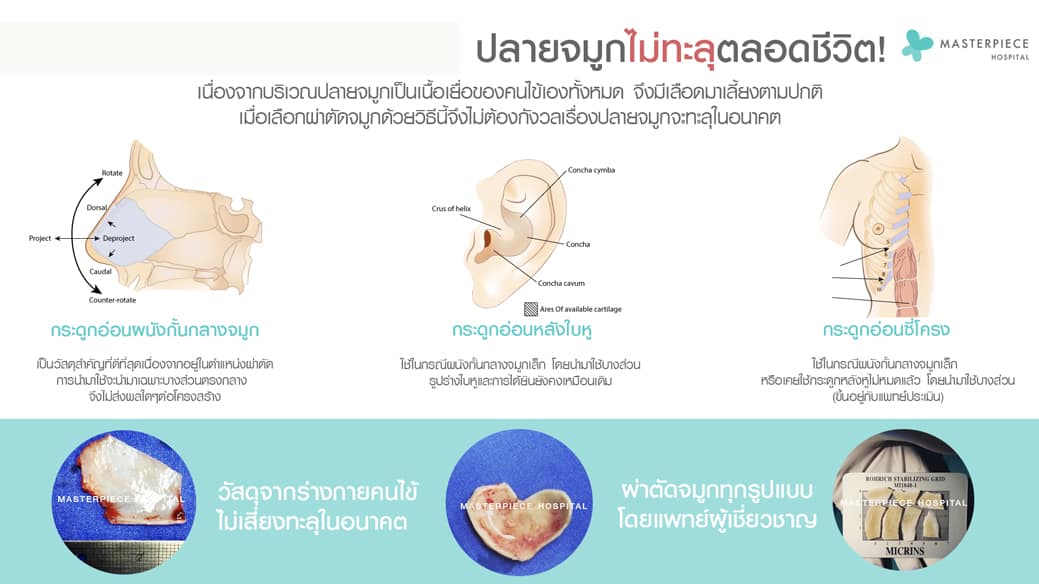 ข้อดีของการ เสริมจมูก แบบOpen