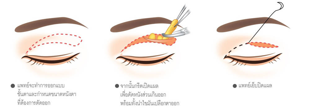 FULL INCISION DOUBLE EYES ศัลยกรรมตาสองชั้นเทคนิคเปิดแผลยาว