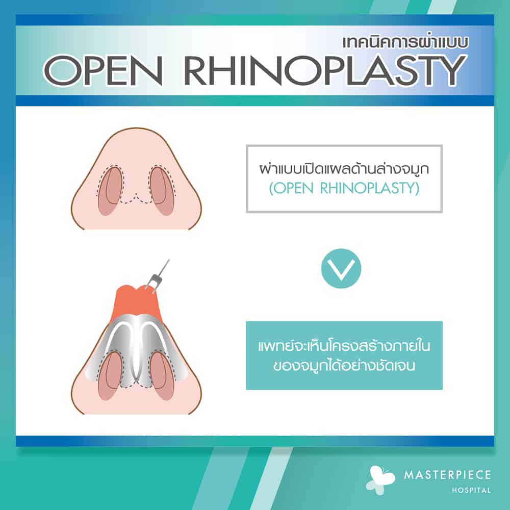 เทคนิคการผ่าตัด เสริมจมูก S60