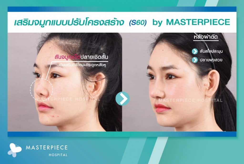 รีวิว เสริมจมูก S60