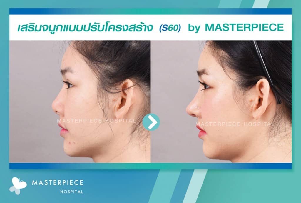 รีวิว เสริมจมูก S60